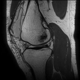 Anterior cruciate ligament rupture with Segond fracture (Radiopaedia 69043-78806 Sagittal PD 76).jpg