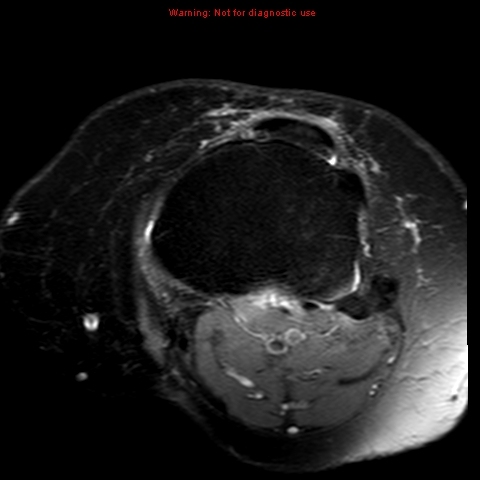 File:Anterior cruciate ligament tear (Radiopaedia 12329-12612 Axial T2 fat sat 5).jpg