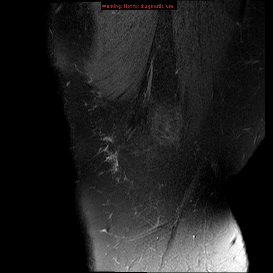 File:Anterior cruciate ligament tear (Radiopaedia 12329-12612 E 22).jpg