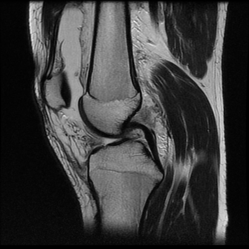File:Anterior cruciate ligament tear (Radiopaedia 61500-69462 Sagittal T2 9).jpg