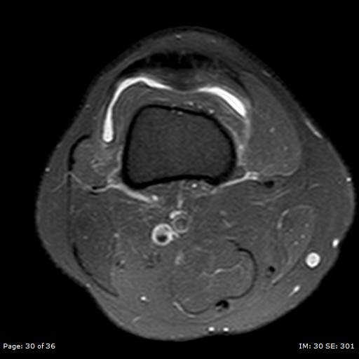 File:Anterior cruciate ligament tear (Radiopaedia 70783-80964 Axial PD fat sat 30).jpg
