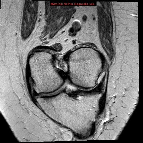 File:Anterior cruciate ligament tear - complete (Radiopaedia 12175-12514 Coronal PD 6).jpg