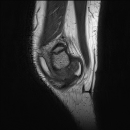 File:Anterior cruciate ligament tear - pediatric (Radiopaedia 62152-70260 Sagittal PD 25).jpg