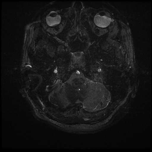Anterior inferior cerebellar artery vascular loop - type II (Radiopaedia 70991-81209 Axial 3D FIESTA 77).jpg