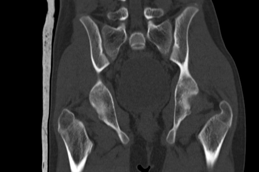 Anterior inferior iliac spine avulsion injury (Radiopaedia 88666-105376 Coronal bone window 45).jpg