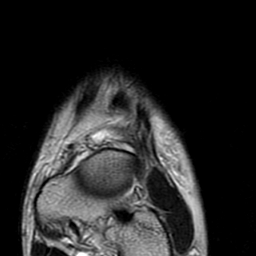 File:Anterior talofibular ligament rupture (Radiopaedia 15831-15484 Coronal T2 2).jpg