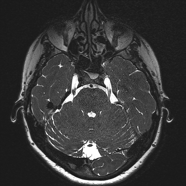 Anterior temporal encephalocele (Radiopaedia 82624-96808 Axial T2 high res 41).jpg