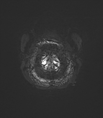 File:Anterior temporal lobe perivascular space (Radiopaedia 40946-43650 Axial SWI 88).png