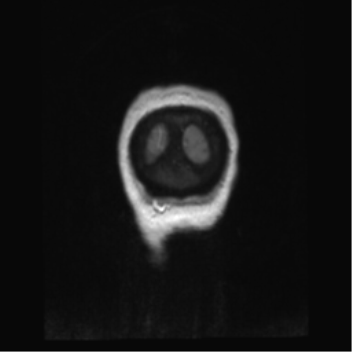 Anterior temporal pole cysts (Radiopaedia 46629-51102 Coronal T1 C+ 2).png