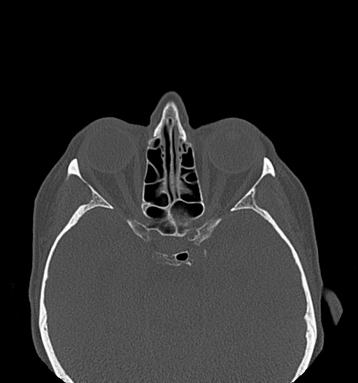 File:Anterior temporomandibular joint dislocation (Radiopaedia 59430-66784 Axial non-contrast 1).jpg
