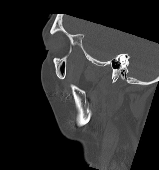 File:Anterior temporomandibular joint dislocation (Radiopaedia 59430-66784 B 52).jpg