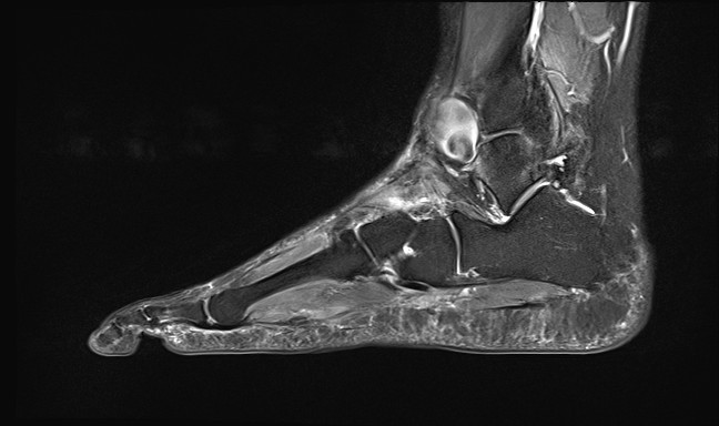 File:Anterior tibial artery false aneurysm (Radiopaedia 88984-105808 Sagittal STIR 11).jpg
