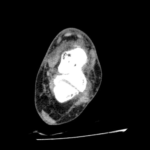 Anterior tibial artery false aneurysm (Radiopaedia 88984-105809 A 150).jpg