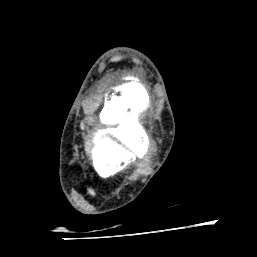 Anterior tibial artery false aneurysm (Radiopaedia 88984-105809 A 151).jpg