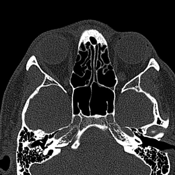 Antrochoanal polyp (Radiopaedia 30002-30554 Axial bone window 38).jpg