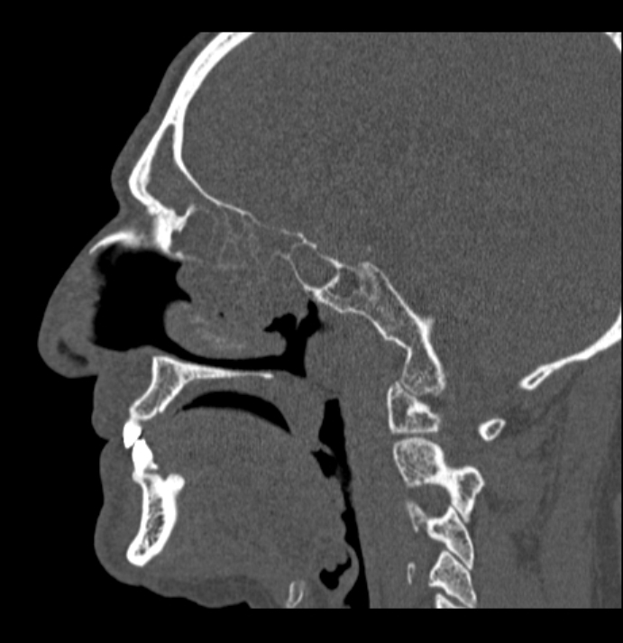 Antrochoanal polyp (Radiopaedia 79011-92169 Sagittal bone window 40).jpg