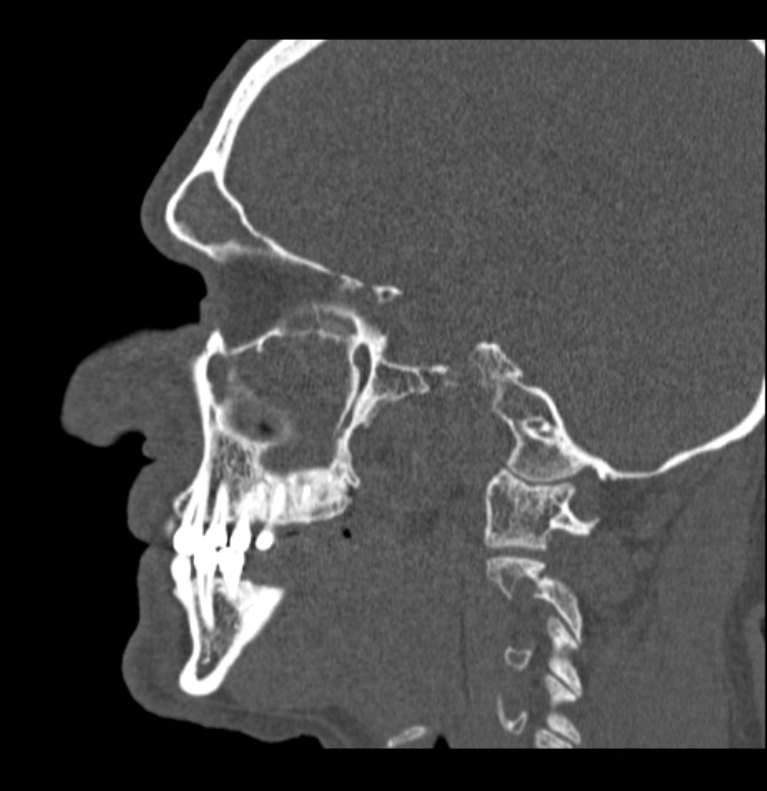 Antrochoanal polyp (Radiopaedia 79011-92169 Sagittal bone window 48).jpg