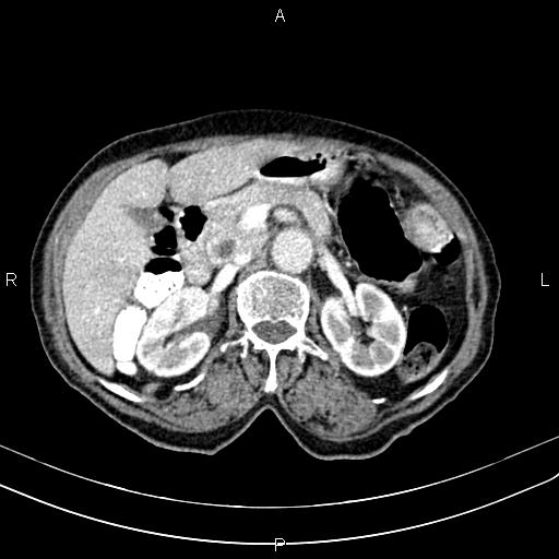 File:Aortic aneurysm and Lemmel syndrome (Radiopaedia 86499-102554 A 31).jpg