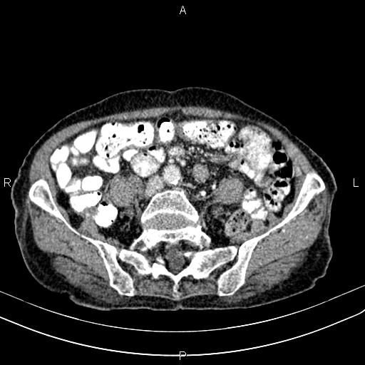 Aortic aneurysm and Lemmel syndrome (Radiopaedia 86499-102554 A 55).jpg