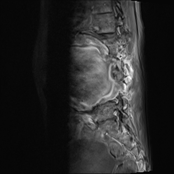 File:Aortic aneurysm with spinal destruction (Radiopaedia 42301-45409 Sagittal T1 fat sat 21).jpg