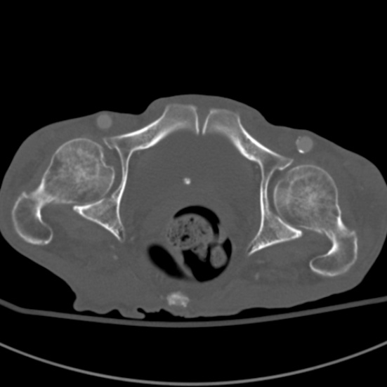 Aortic aneurysm with spinal destruction (Radiopaedia 42301-45410 Axial bone window 109).jpg