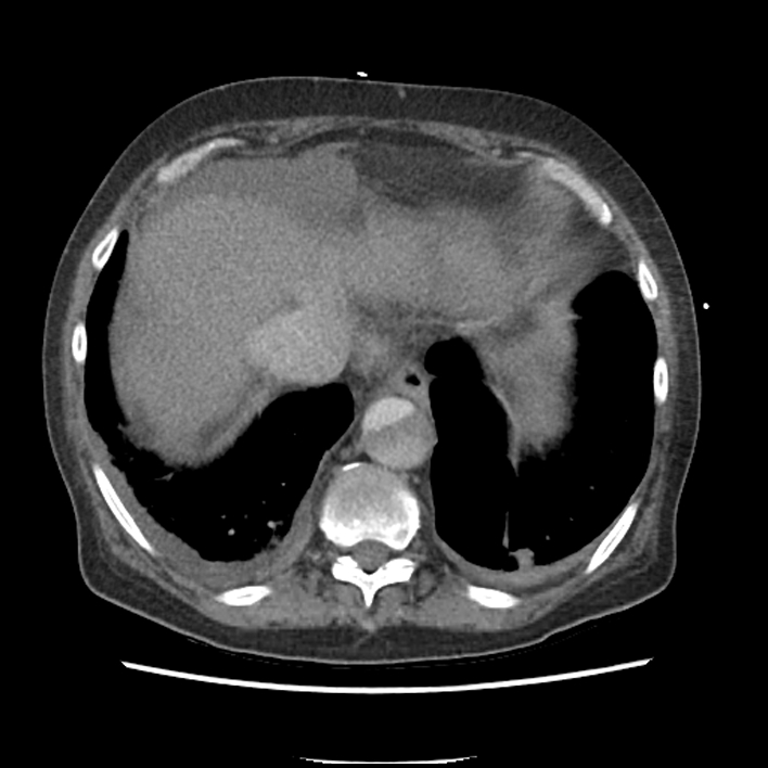 Aortic arch graft infection (FDG PET-CT) (Radiopaedia 71975-82437 A 52).jpg