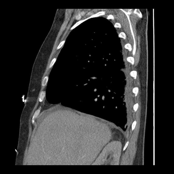 Aortic arch graft infection (FDG PET-CT) (Radiopaedia 71975-82437 C 17).jpg