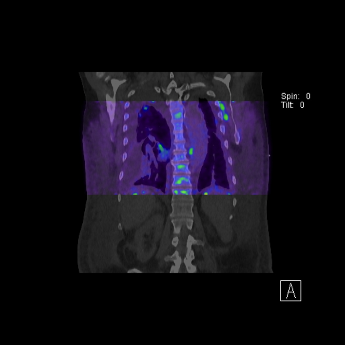 Aortic arch graft infection (FDG PET-CT) (Radiopaedia 71975-82438 D 64).jpg