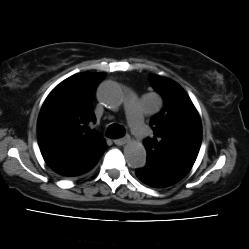 Aortic arch pseudoaneurysm (Radiopaedia 8534-9368 Axial non-contrast 27).jpg