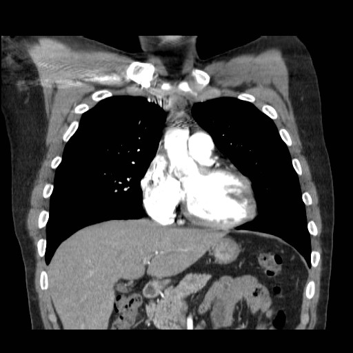 File:Aortic arch stent (Radiopaedia 30030-30595 F 4).jpg
