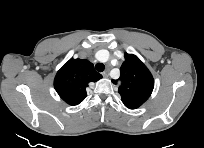 File:Aortic coarctation with aneurysm (Radiopaedia 74818-85828 A 163).jpg