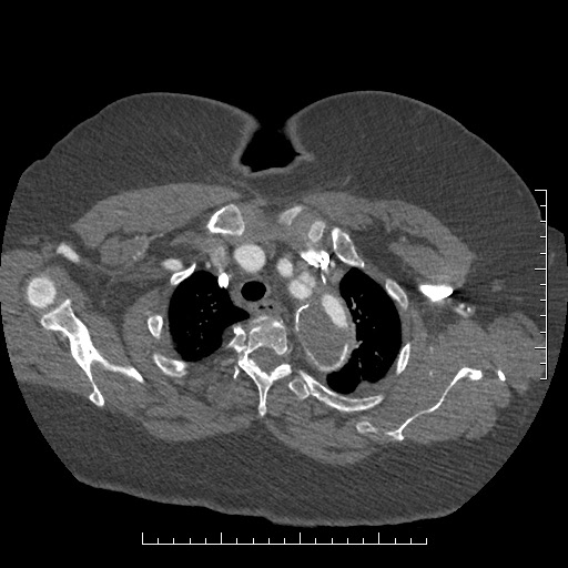 Aortic dissection- Stanford A (Radiopaedia 35729-37268 A 7).jpg