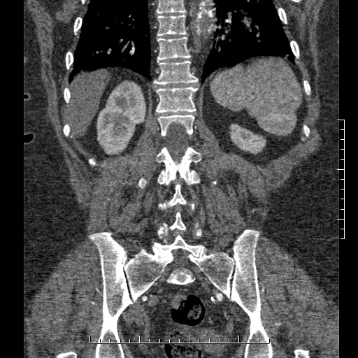 Aortic dissection- Stanford A (Radiopaedia 35729-37268 F 4).jpg