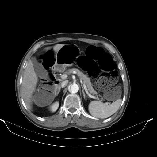 Aortic dissection- Stanford type A (Radiopaedia 22085-22085 A 42).jpg