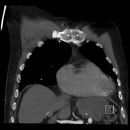 Aortic dissection (CTPA) (Radiopaedia 75506-86750 B 18).jpg