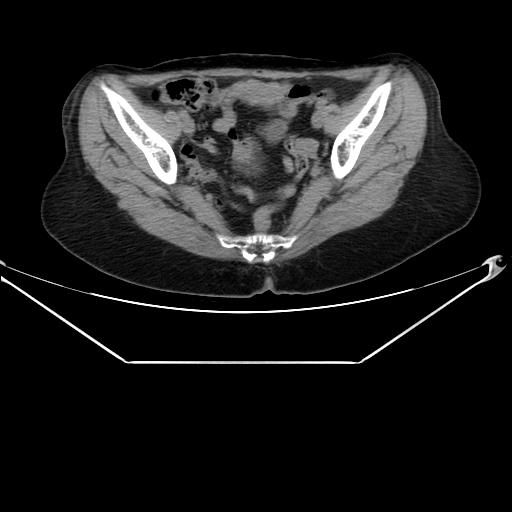 File:Aortic dissection (Radiopaedia 25350-25604 B 68).jpg