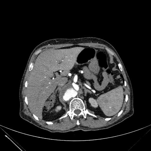 Aortic dissection (Radiopaedia 27466-27665 C+ arterial phase 287).jpg
