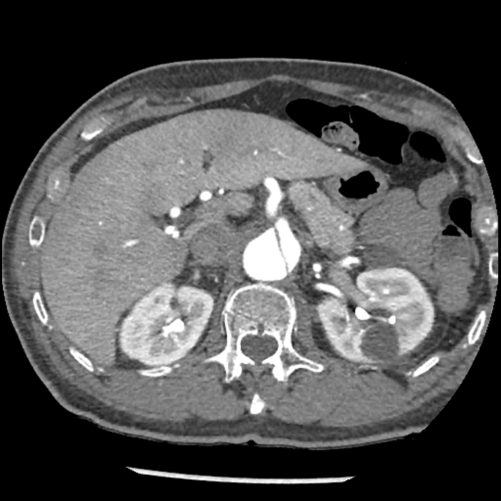 Aortic dissection - DeBakey Type I-Stanford A (Radiopaedia 79863-93115 A 43).jpg