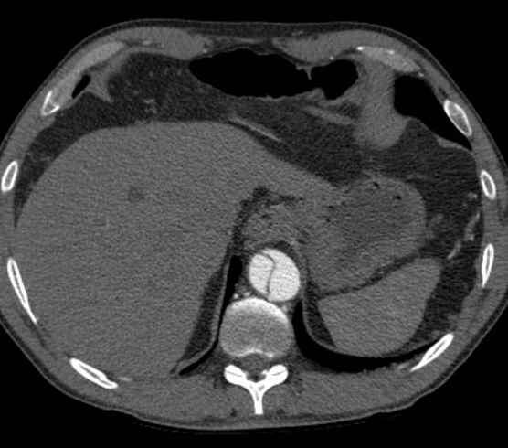 Aortic dissection - Stanford type B (Radiopaedia 73648-84437 A 102).jpg