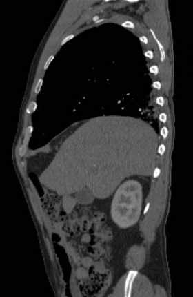 File:Aortic dissection - Stanford type B (Radiopaedia 73648-84437 C 120).jpg
