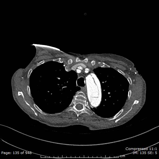 File:Aortic dissection with extension into aortic arch branches (Radiopaedia 64402-73204 B 135).jpg