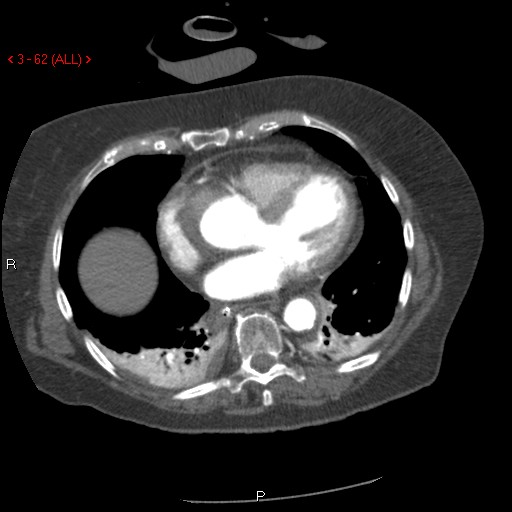 File:Aortic intramural hematoma (Radiopaedia 27746-28001 A 62).jpg