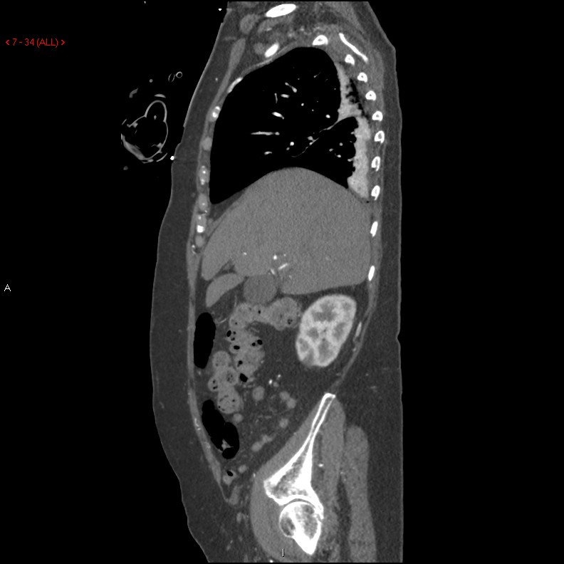 Aortic intramural hematoma (Radiopaedia 27746-28001 C 3).jpg