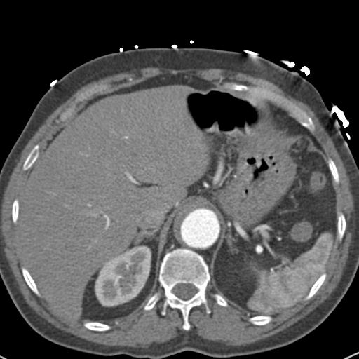 Aortic intramural hematoma (Radiopaedia 31139-31838 B 81).jpg