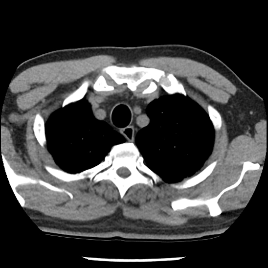 Aortic intramural hematoma (type B) (Radiopaedia 79323-92387 Axial non-contrast 6).jpg