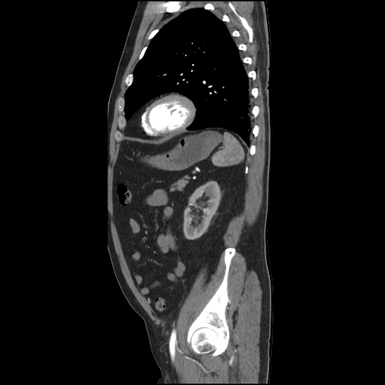 Aortic intramural hematoma (type B) (Radiopaedia 79323-92387 H 41).jpg