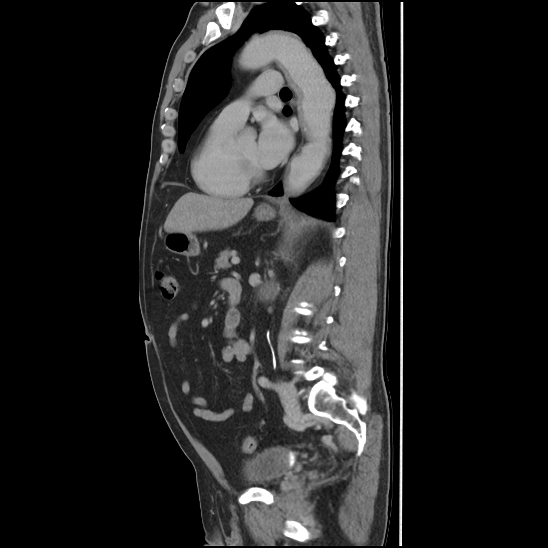 Aortic intramural hematoma (type B) (Radiopaedia 79323-92387 Sagittal C+ delayed 31).jpg