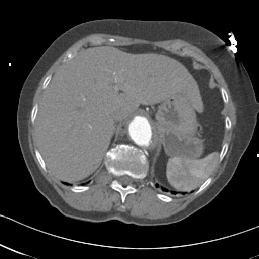 File:Aortic intramural hematoma from penetrating atherosclerotic ulcer (Radiopaedia 31137-31836 A 74).jpg