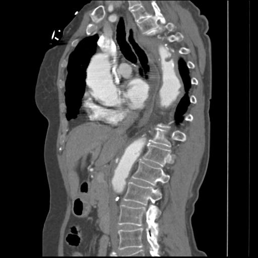 File:Aortic intramural hematoma from penetrating atherosclerotic ulcer (Radiopaedia 31137-31836 B 22).jpg