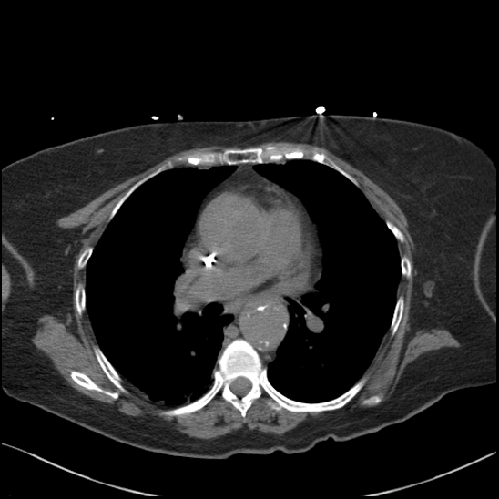 File:Aortic intramural hematoma with dissection and intramural blood pool (Radiopaedia 77373-89491 Axial non-contrast 46).jpg